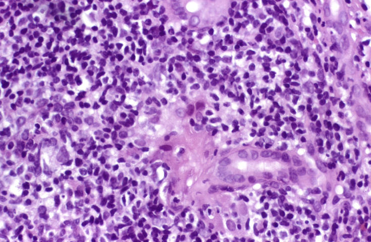 Microphotograph of hepatitis C. Credit: University of Alabama at Birmingham Department of Pathology/Peter Anderson